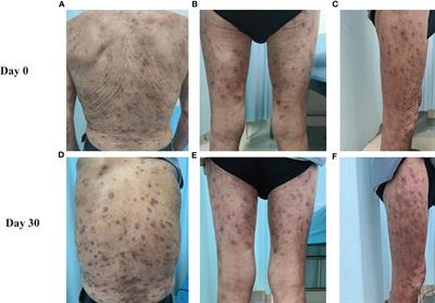 Case Report: Prurigo nodularis-like linear IgA/IgG bullous dermatosis: a case report and literature review